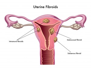 Uterine Fibroids pic